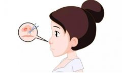 鼻尖缩小术有什么副作用