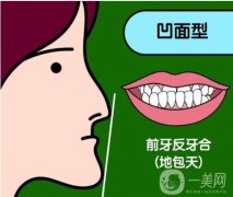 骨性凸嘴需要正颌手术吗？