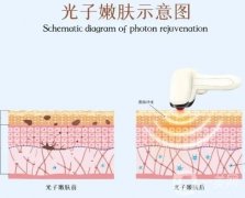 光子嫩肤的原理是什么，光子嫩肤后要注意什么