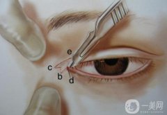 开眼角会让眼睛变大吗？开内眼角回缩过程图点击查看