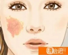 激光去除胎记可能有哪些后遗症