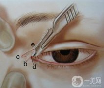 开眼角手术后应该怎么做好护理