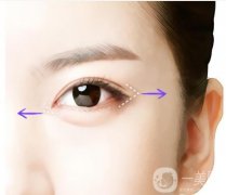 开眼角手术的流程是怎么样的？