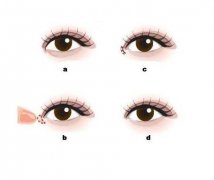 开眼角术后有没有疤痕？