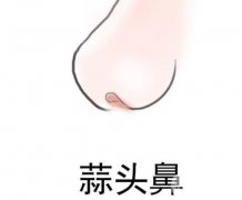 蒜头鼻整形图片对比！整形风险大吗？可以维持一辈子吗