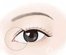 哪些因素与开眼角手术的恢复期有关?