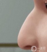 驼峰鼻手术一般多少钱？驼峰鼻和鹰钩鼻区别对比一览