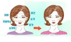 热玛吉去眼袋有没有效果