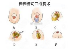 缩胸手术的疤痕图片一览，缩胸手术的疤痕去除多久可以恢复?