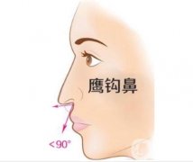 鹰钩鼻矫正的怎么样，需要多少钱