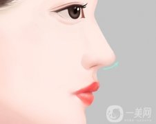 鹰钩鼻矫正的恢复期需要多长时间