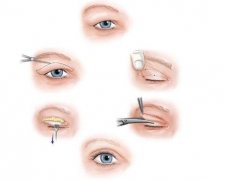 割双眼皮后快速消肿的方法有哪些