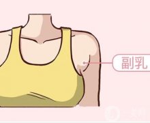 副乳切除术后怎么护理