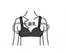 副乳切除术后需要多久才能恢复?