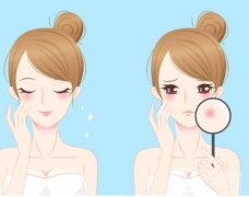 激光祛痘有什么原理及注意事项