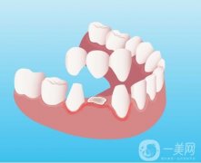 烤瓷牙有哪些优点以及烤瓷牙出现问题的原因