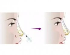 哪些因素影响线雕隆鼻术后的肿胀时间