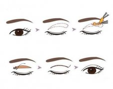 双眼皮手术有几种类型？