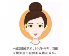 双眼皮手术后需要多长时间才能恢复？