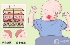 鲜红斑痣能不能彻底治好？鲜红斑痣激光几次能好？