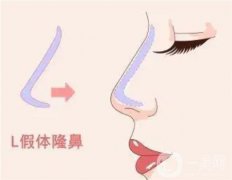 线雕隆鼻和假体隆鼻有什么不同?