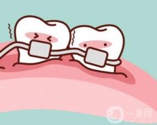 有哪些矫正地包天的手术方法？