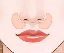 隆鼻修复多久能恢复？整鼻子大概多少钱？