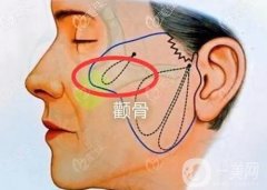 颧骨很高怎么办？颧骨太高是怎么造成的？