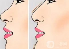 鞍鼻有哪些症状，鞍鼻整形手术效果如何