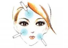 玻尿酸注射除皱效果好吗？玻尿酸除皱有哪些优势