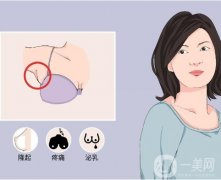 副乳切除术后如何护理有利于康复