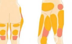 腰腹吸脂后注意事项有哪些？吸脂后多久可以恢复？