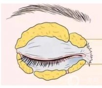 开眼角失败修复后需要多长时间才能恢复