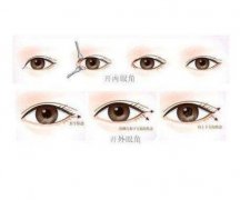 开眼角后眼角会不会回缩