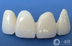 乌鲁木齐烤瓷牙多少钱？烤瓷牙的适宜人群盘点