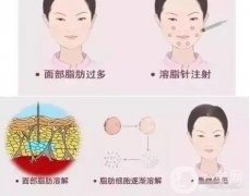 面部吸脂术后为什么要戴头套