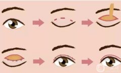 现在做双眼皮什么技术好？推荐两种：切开法、埋线法