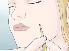 激光去痣后有哪些禁忌？这几点一定要记住喔！