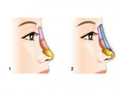 取出膨体隆鼻材料会发生什么变化？