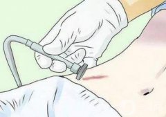 激光祛疤一般要做几次？除疤费用概况揭秘