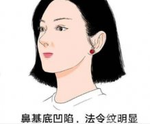 什么决定了鼻基底填充的价格