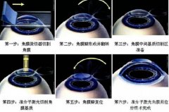 飞秒半飞秒激光手术三者区别是什么？半飞秒分几种类型详解