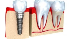 烟台种植牙医院哪家比较好？汇总五家口碑测评，附价目表参考