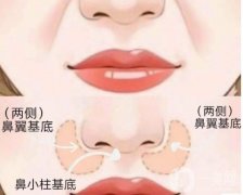 鼻基底填充有哪些作用，哪些人适合