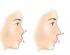 鼻基底填充的材料有哪些？