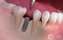 佛山种牙多少钱一颗啊？价格费用详细_靠谱医院测评3家