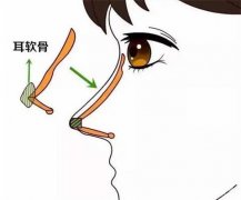 肋骨隆鼻多少钱？肋骨隆鼻和耳软骨哪个好？医院点评