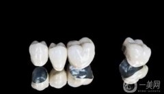 烤瓷牙的种类及价钱表揭晓，看使用寿命多久？