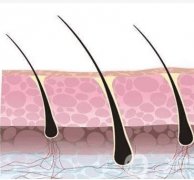 激光和强脉冲光有什么不同