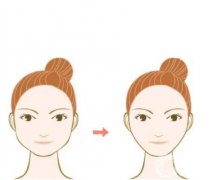 决定面部吸脂的安全性的因素有哪些